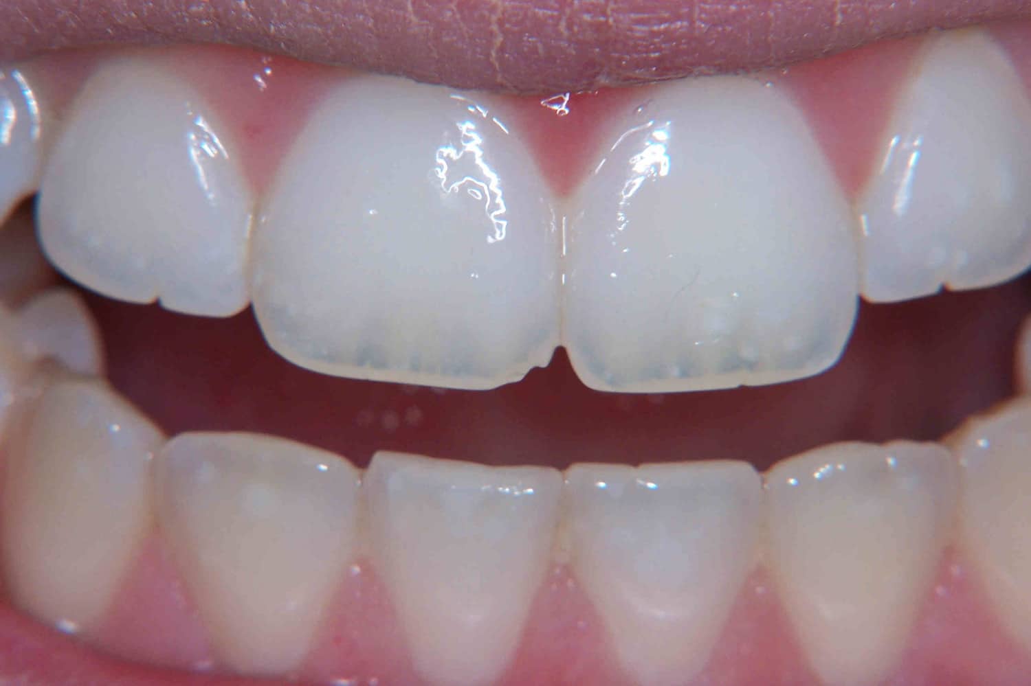 a women showing her teeth during receiving teeth whitening before