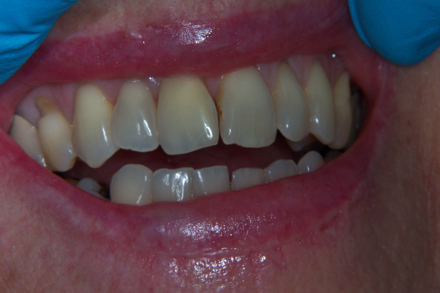 a dental patient showing her teeth during receiving teeth whitening before