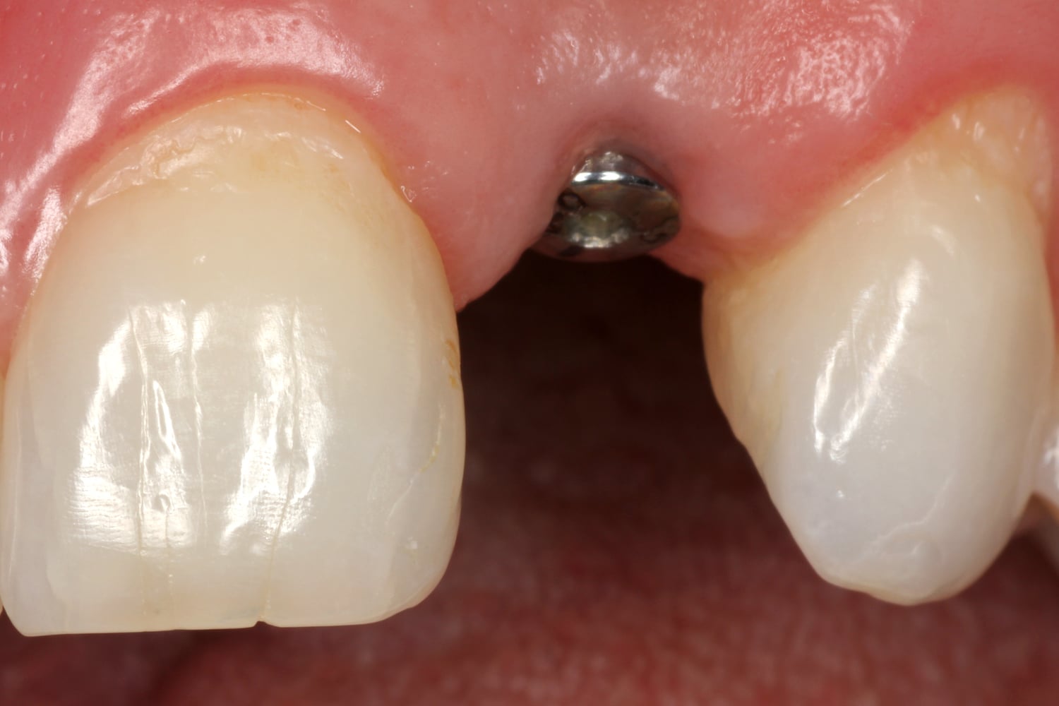 Anterior-Implant Before
