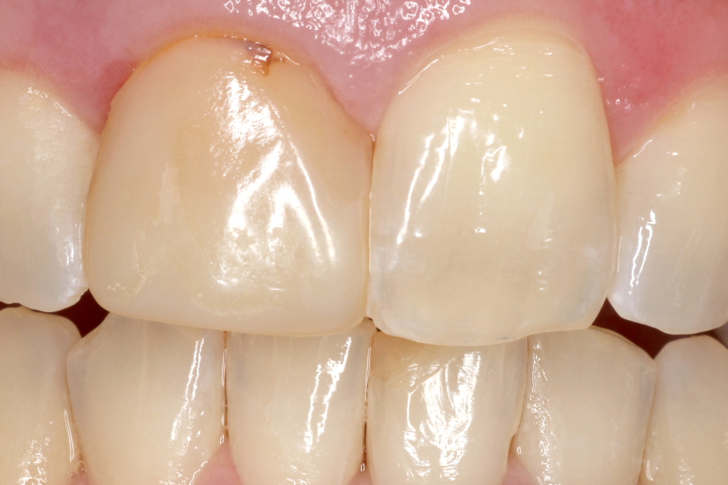 Complete Anterior Implant