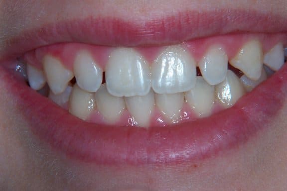 a women showing her teeth