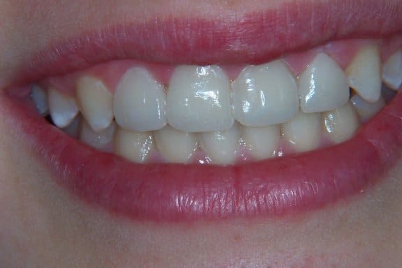 a women showing her teeth
