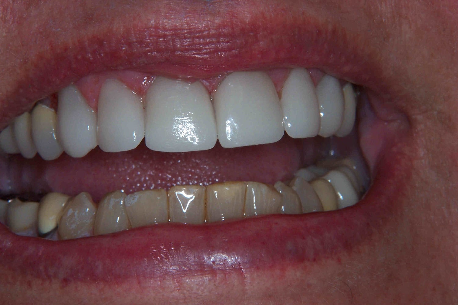 a women showing her teeth during receiving teeth whitening