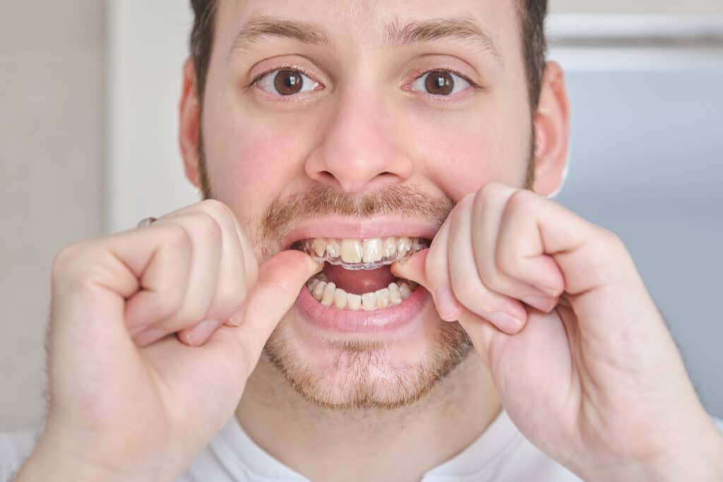 Close up of young latin man putting invisible braces aligner