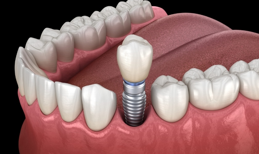 Healing after dental implants tips