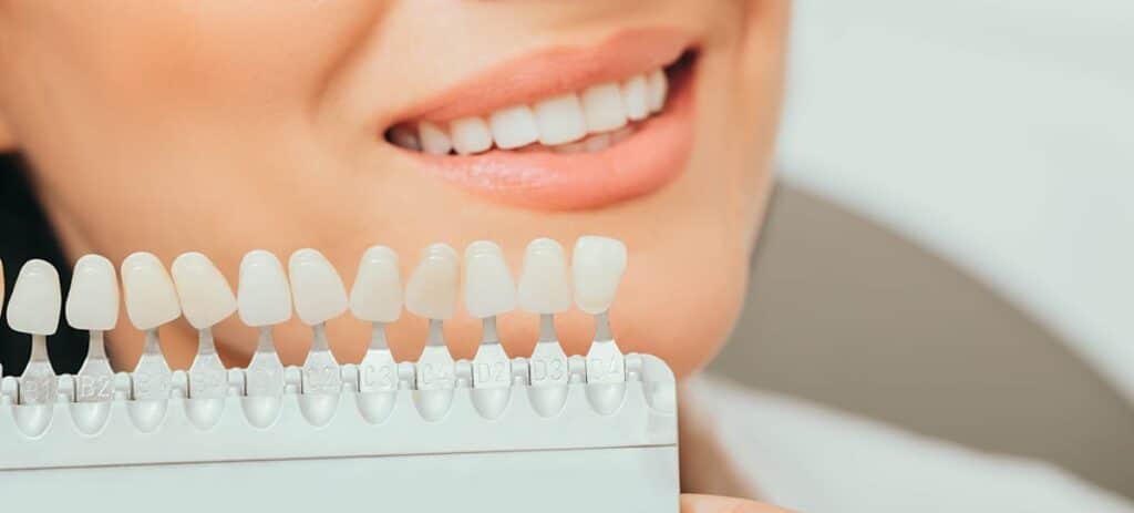 Veneers in Newport Beach